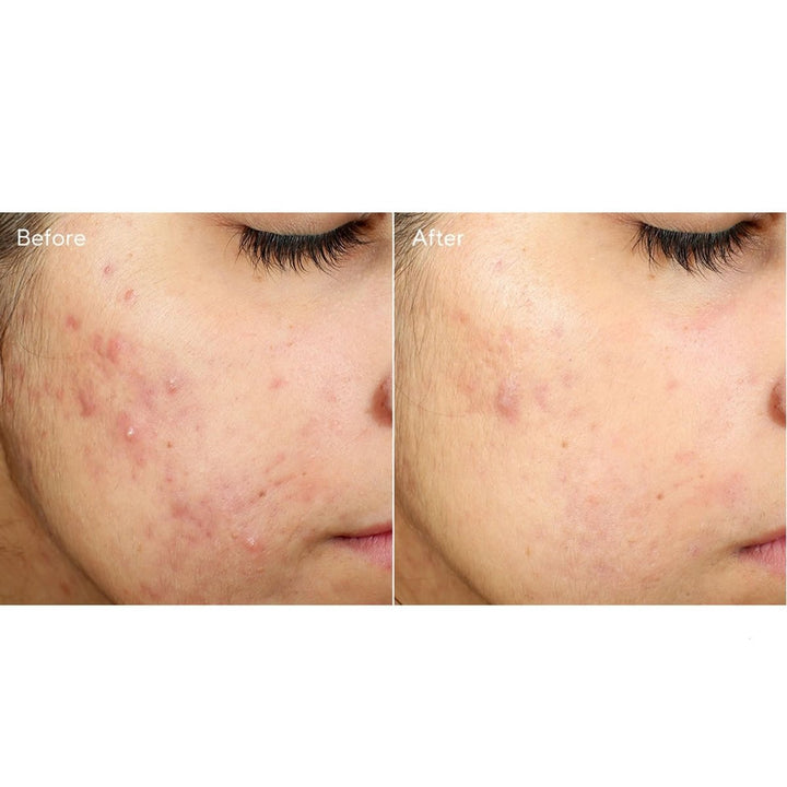 Murad Invisiscar Resurfacing Treatment crema acne 15ml - Imperfezioni - Beauty
