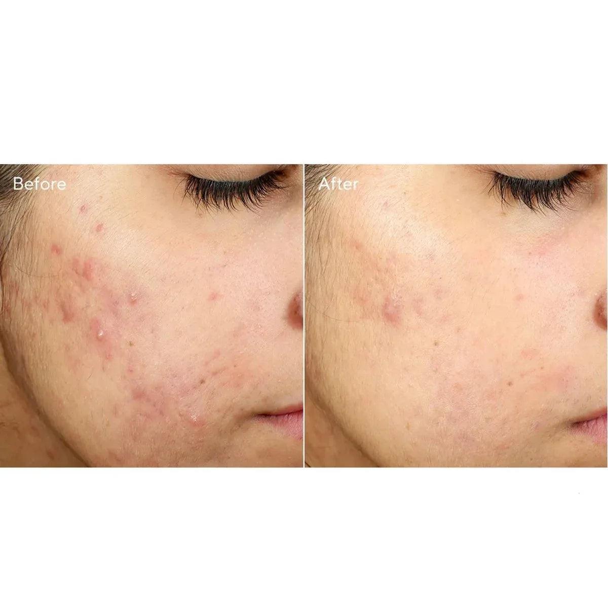 Murad Invisiscar Resurfacing Treatment crema acne 15ml - Planethair