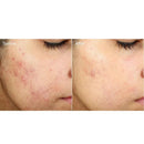 Murad Invisiscar Resurfacing Treatment crema acne 15ml - Planethair