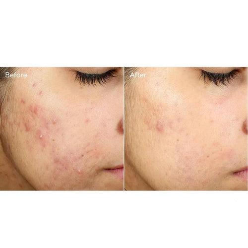 Murad Invisiscar Resurfacing Treatment crema acne 15ml - Planethair